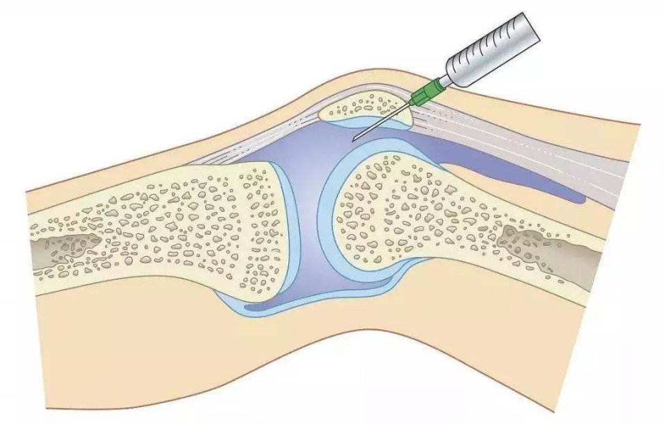 膝盖长了骨刺腿弯处疼怎么办,膝盖关节炎天冷了疼怎么办