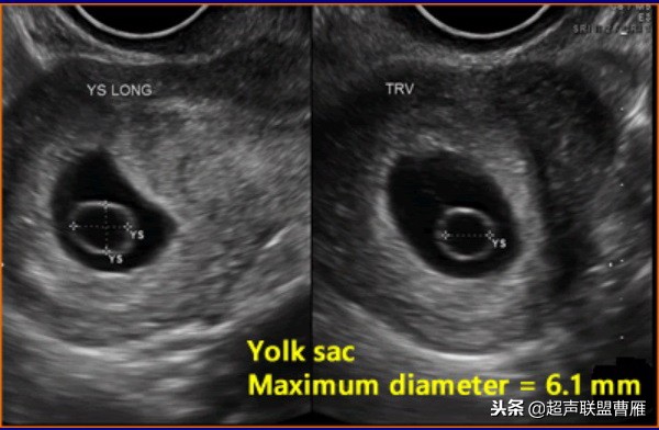 内见卵黄囊,卵黄囊肿瘤