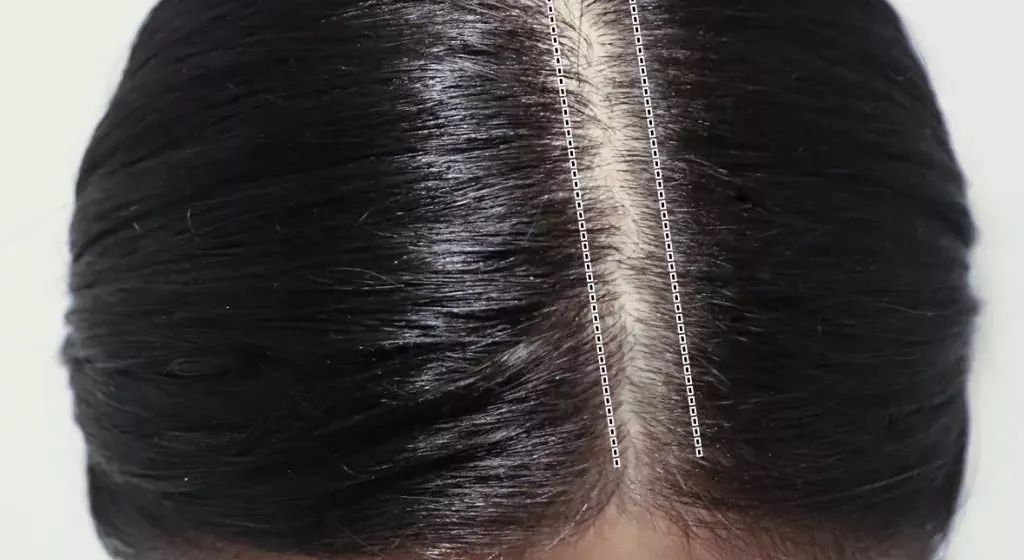 论秃头少女如何自救,秃头少女自救技巧