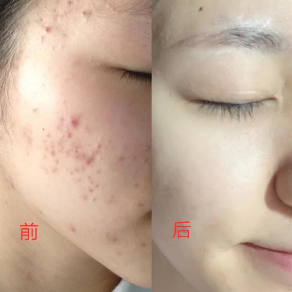 女子为变美花掉300余万后续,女子为变美脸塌陷