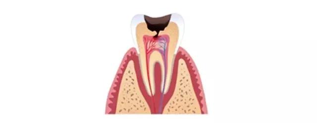补牙补到牙齿都秃没了,补牙快到牙神经了补完咬合疼