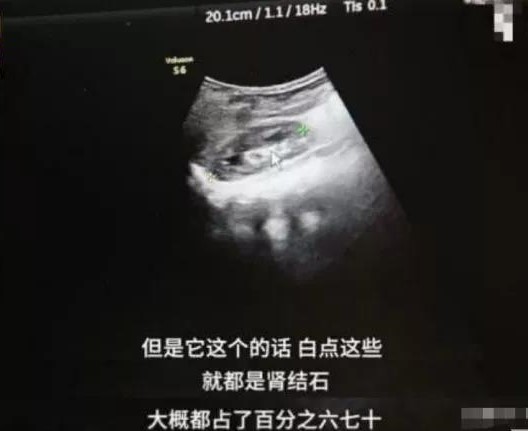 10个月宝宝肾结石需要做手术吗,十个月宝宝肾结石怎么办