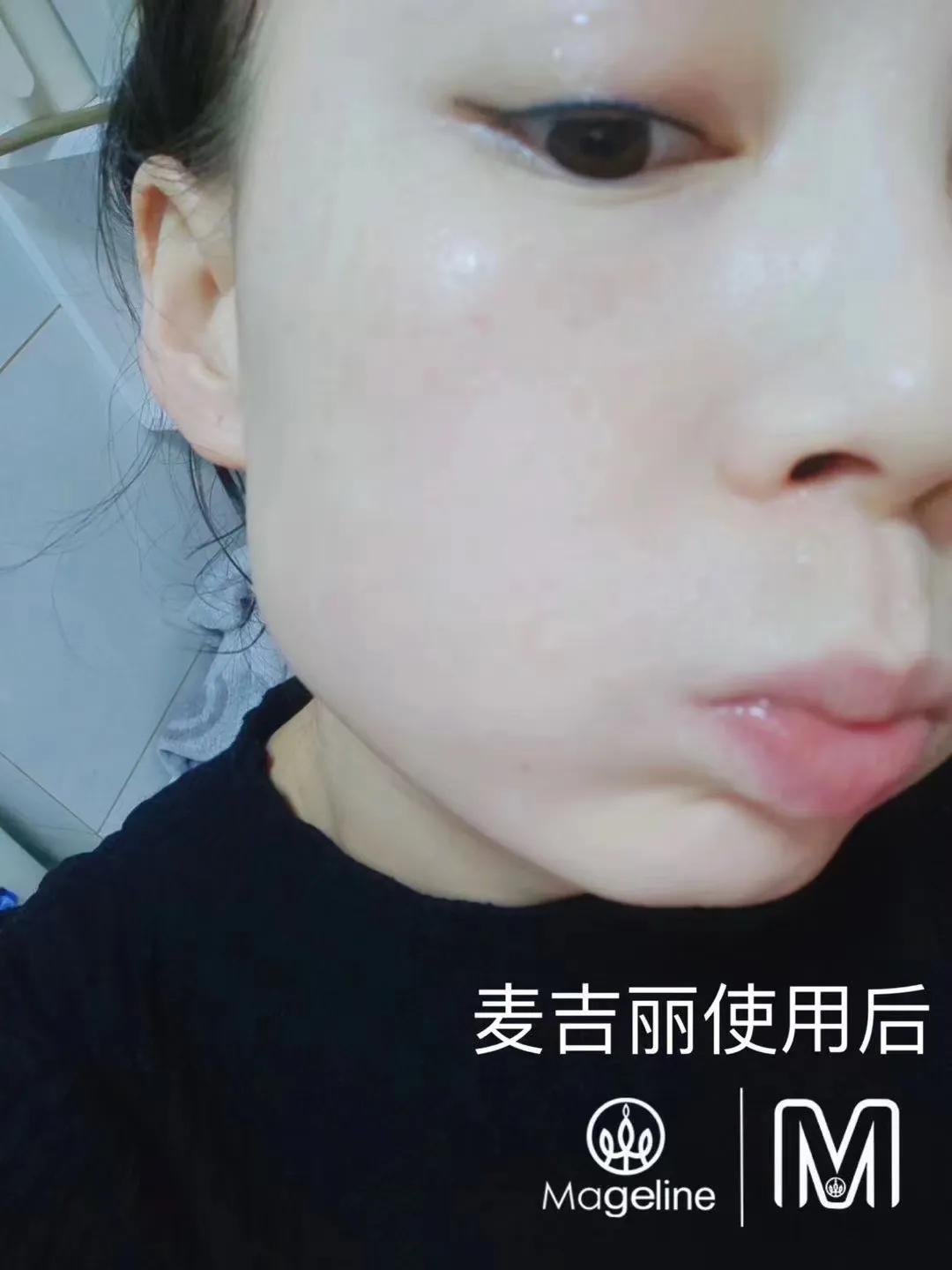 甜甜专业祛斑祛痘,甜甜祛斑直播间