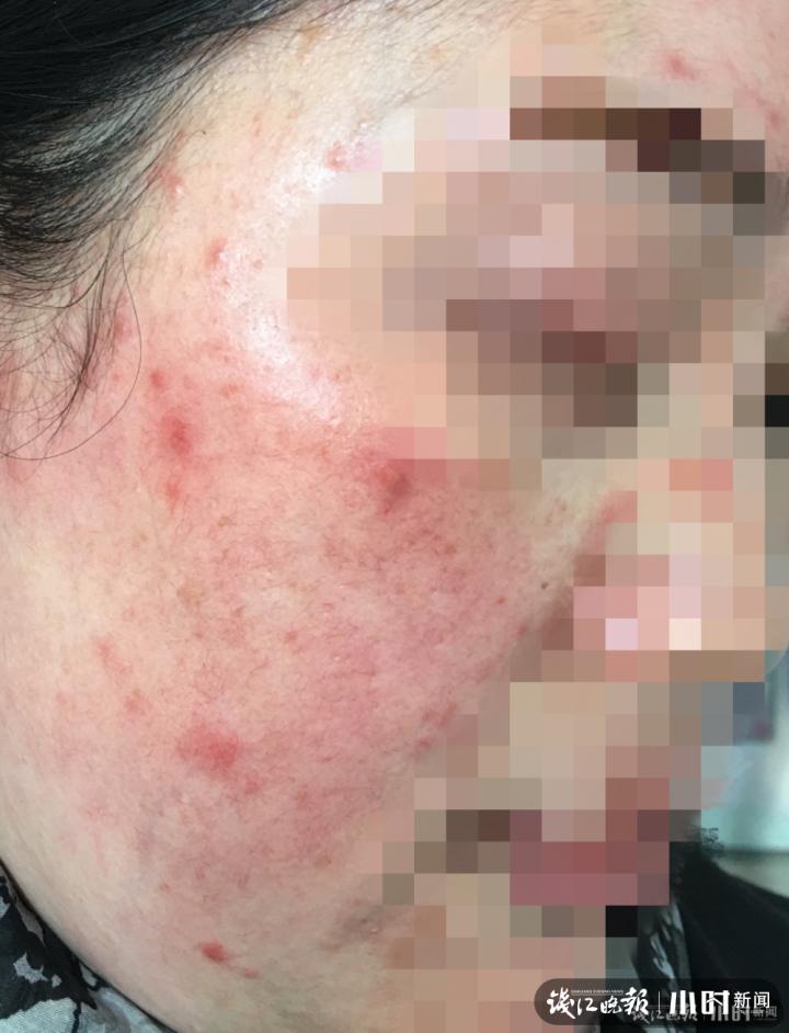 赶紧停用!女子突然“烂脸”,医生:每天接诊七八个