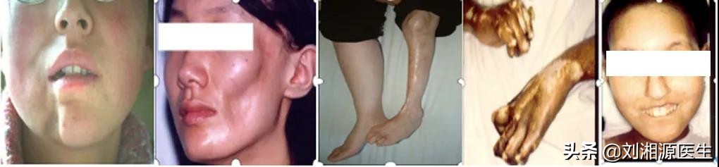 系统性硬化病患者可以怀孕吗,免疫相关不良妊娠诊断指南