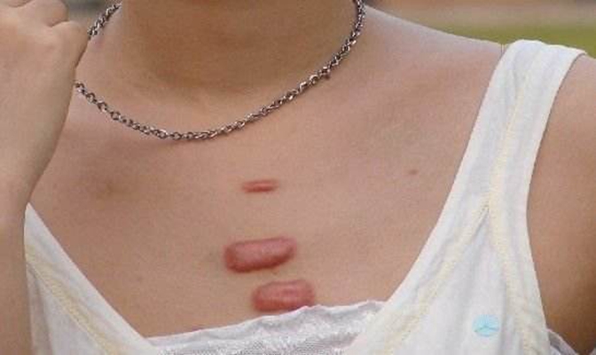 疤痕疙瘩切除后又复发怎么办,增生疤痕疙瘩切除复发率高吗