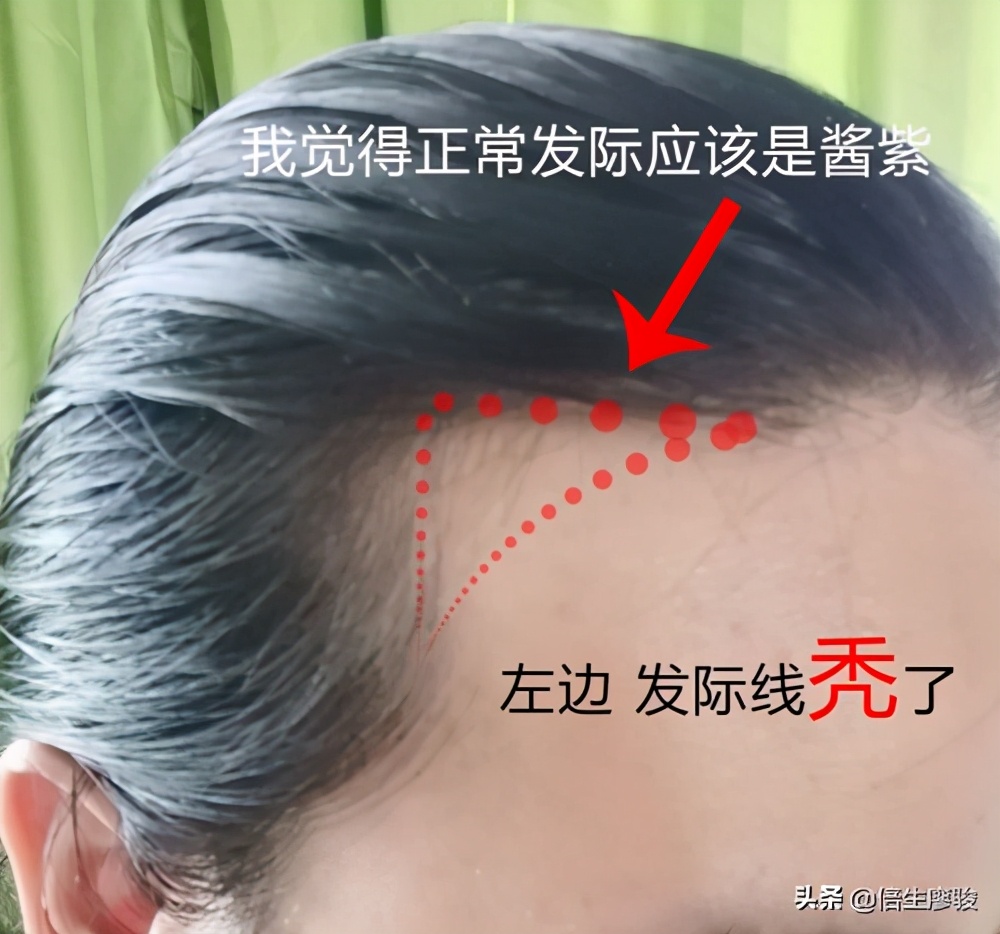 发际线突然秃了一块怎么扎马尾,女生发际线秃了吃什么