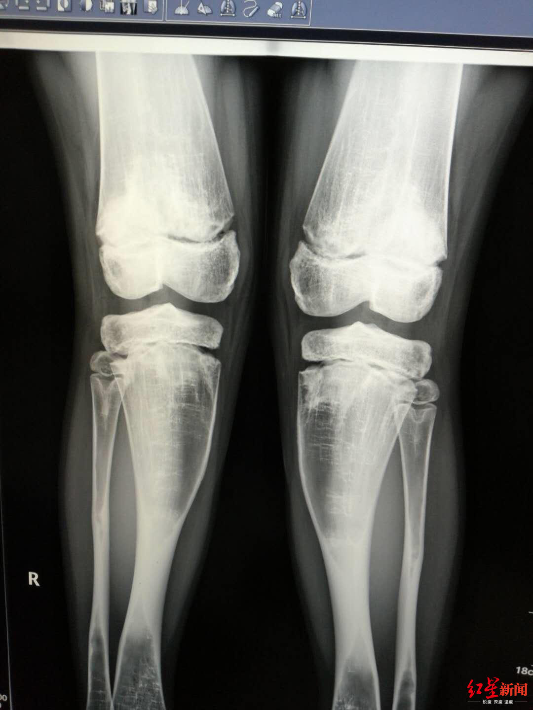 13岁女孩鼻窦炎能治好吗,女童13岁鼻窦炎不治会怎么样呢