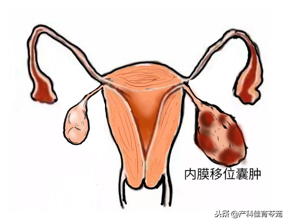 卵巢囊肿是黄体囊肿吗,盆腔囊肿是卵巢囊肿吗