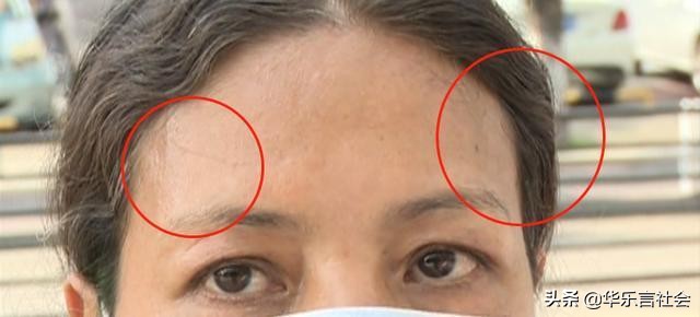 女子整容脂肪填充瘫痪,女子整容额头