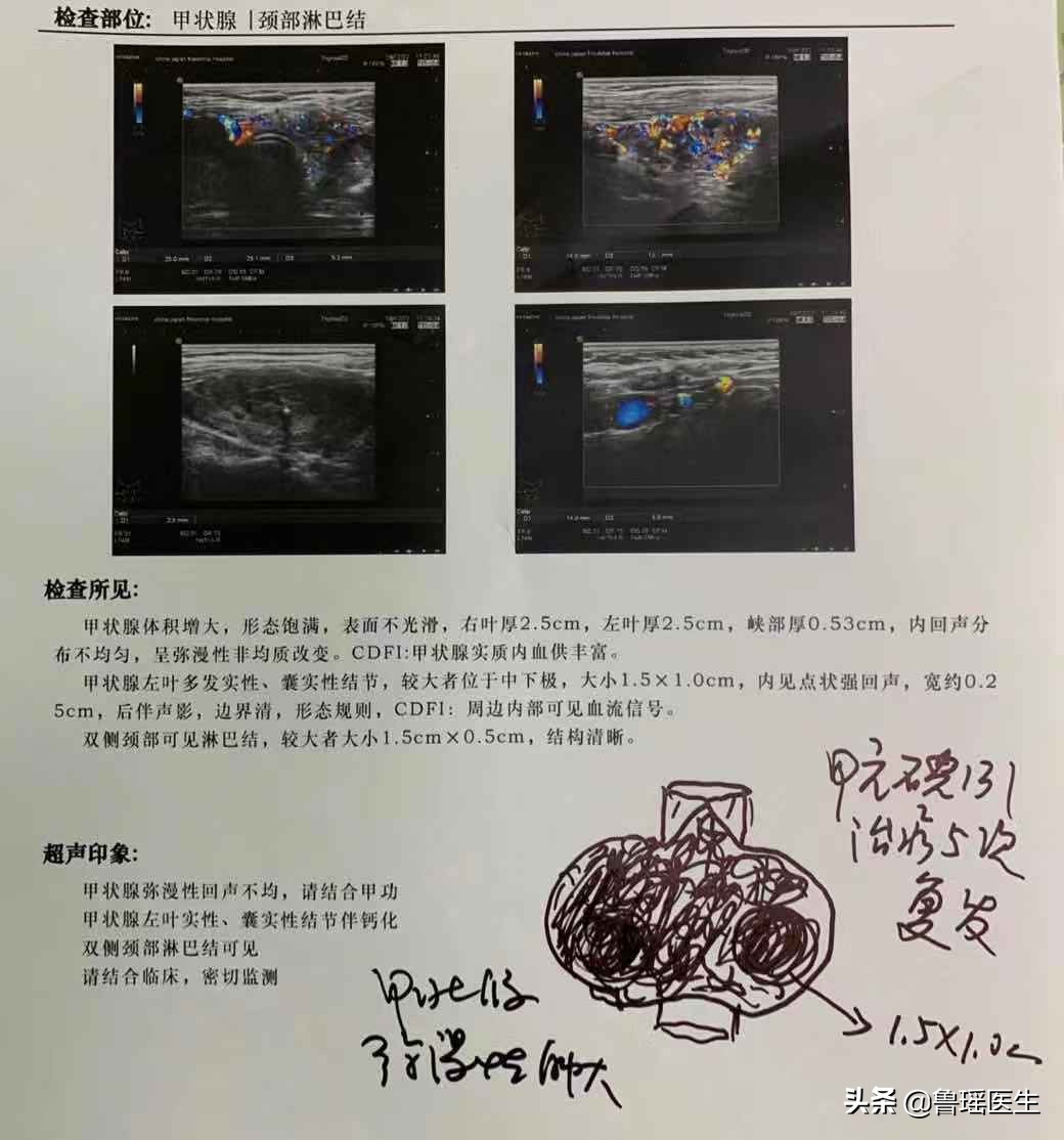 碘131治疗3次了tg值为75,碘131治疗后甲状腺功能的变化