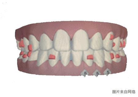 隐形矫正精细调整的流程,做隐形矫正的方案费不能退吗