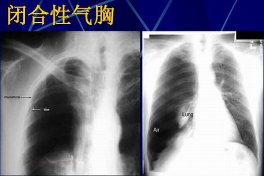 气胸什么情况下需要紧急处理,气胸引起的胸痛持续多久
