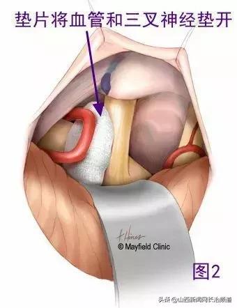 长治市和平医院能做减压手术吗,长治市和平医院动脉介入手术