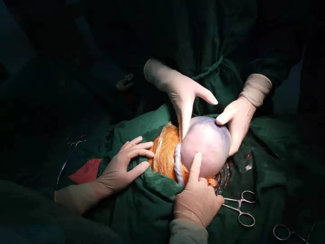 36岁孕妇产下一“透明蛋”,里面的宝宝居然还在动