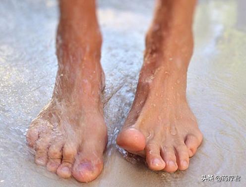 有脚气脚很痒泡陈醋有用吗,真菌感染脚气的水泡在脚底如何办
