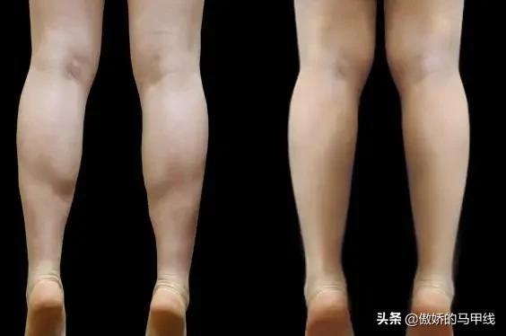 跳绳和跑步哪个会让小腿变粗,运动小腿越来越粗壮