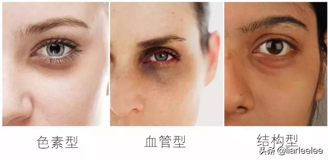 防眼角皱纹最好的方法,眼部皱纹多特别显老