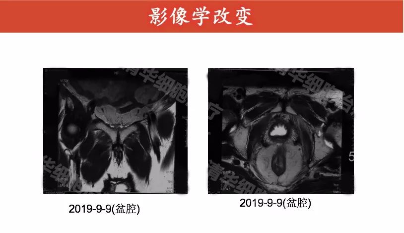 前列腺癌术后psa升高一定是复发吗,前列腺癌术后治疗