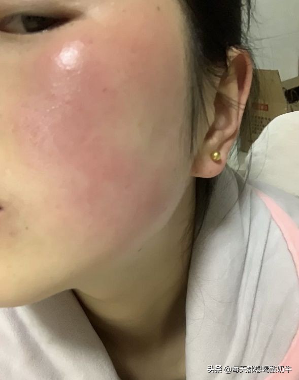 脸部毛孔大泛红有红血丝,脸部毛孔粗大有红血丝怎么改善