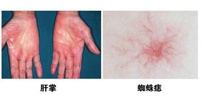 濡備綍璇嗗埆鑲濇帉瑙嗛,鎬庢牱杈ㄥ埆鑲濇帉