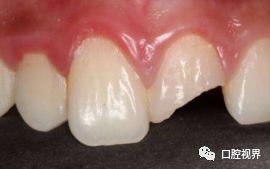 门牙受伤怎么办,门牙撞断了怎么办