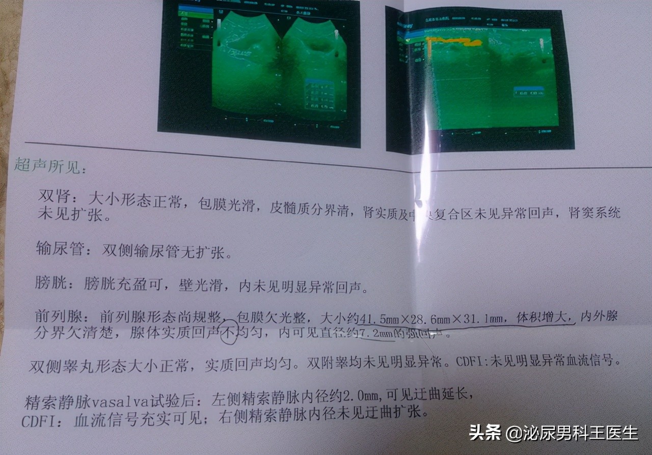 25岁前列腺增生是什么原因引起的,前列腺增生多久做一次psa检查好