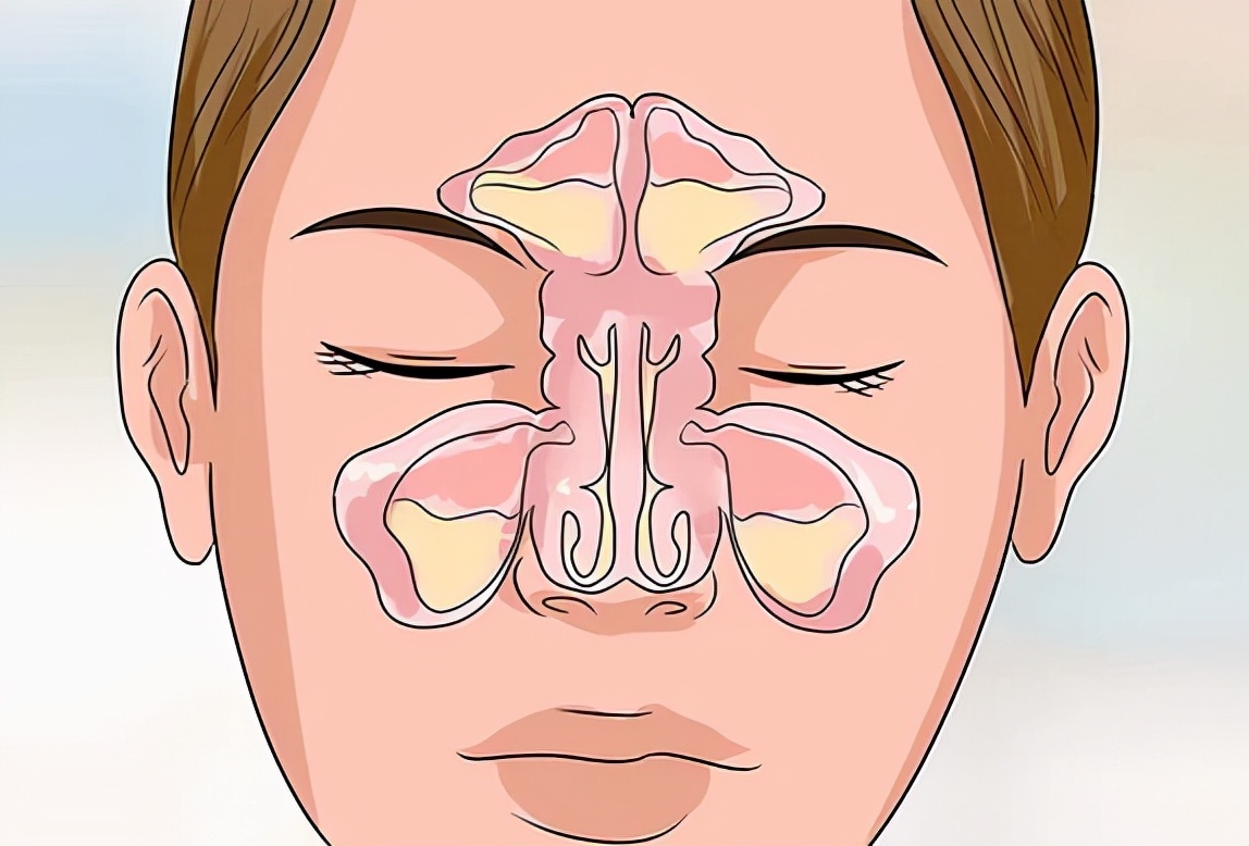 慢性鼻窦炎需要吃多久抗生素,鼻窦炎到底用什么抗生素
