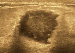 乳腺彩超报告中隐藏的秘密,乳腺结节4a怎么判断良性还是恶性