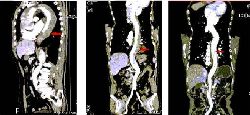 急性心肌梗死的做法,内科主治心肌梗死视频