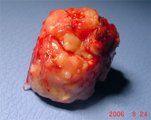 脑囊虫病手术治疗方法及效果,脑包虫治疗方法和费用大概多少