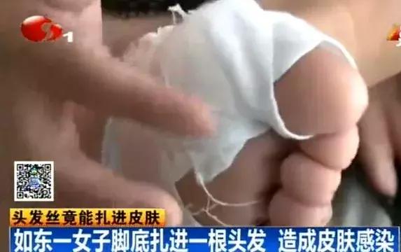 小心！理发的头发碴扎进皮肤，他倒在手术台上