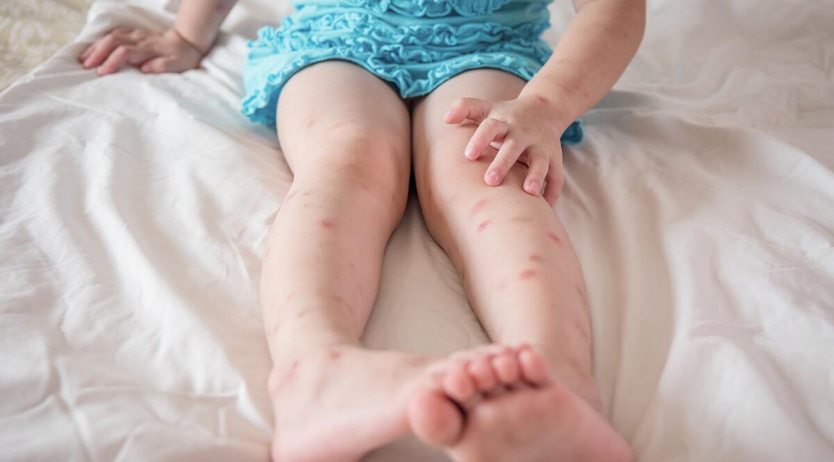 夏天怎么防蚊子咬人,夏天被蚊子咬有办法消灭蚊子