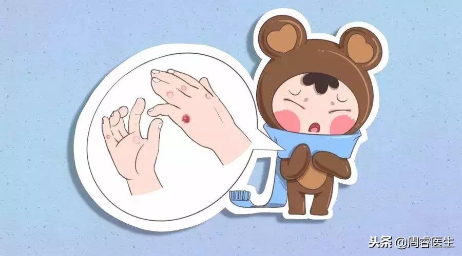 冻疮能用热水泡吗,冻疮能烫吗