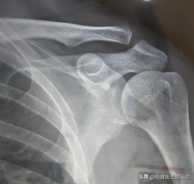 胳膊一动肩膀就咯噔咯噔响,胳膊一动关节就咔咔响筋还疼