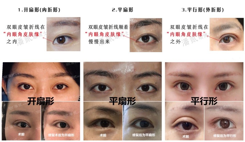 潘贰博士,潘贰博士双眼皮修复技术真的好吗