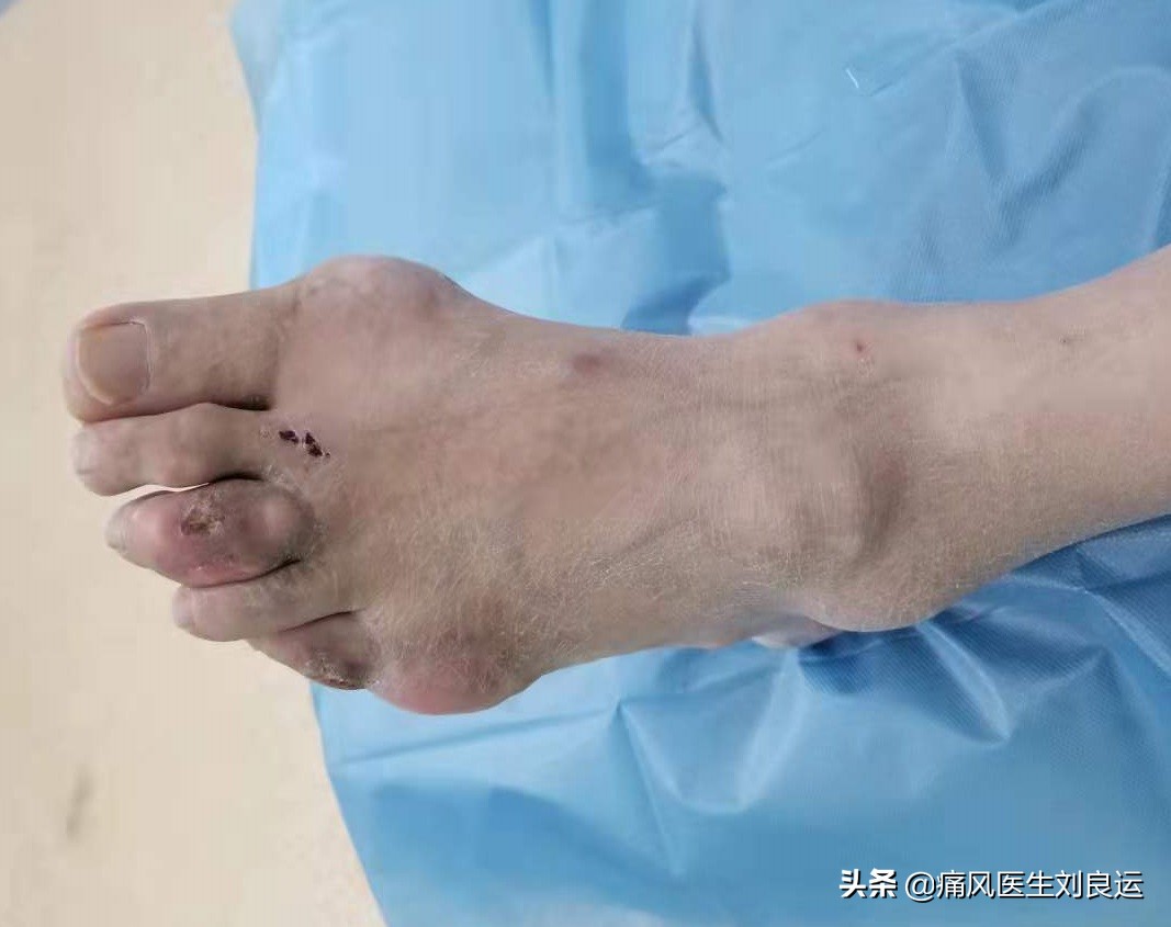 男子扭伤脚后续,原有痛风脚扭伤会诱发痛风吗