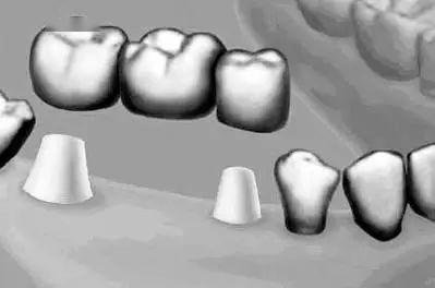 连缺三颗下门牙怎么镶好,明明缺一颗牙为什么要套三颗