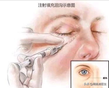 治疗泪沟有哪些方法,泪沟可以用激光治疗吗