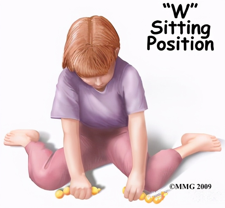 孩子有点内八字怎么矫正,一招解决儿童内八字