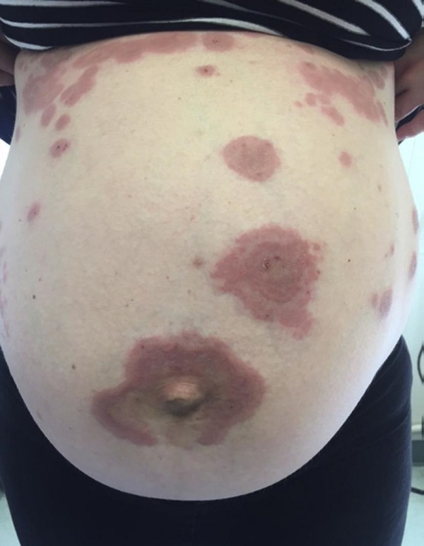 孕期皮肤痒挂什么科,下阴瘙痒去医院挂哪个科