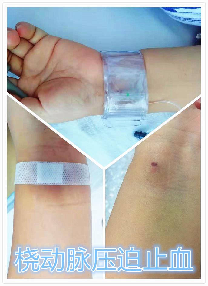 从手上扎针插管就能治子宫腺肌症——经桡动脉入路子宫动脉栓塞术