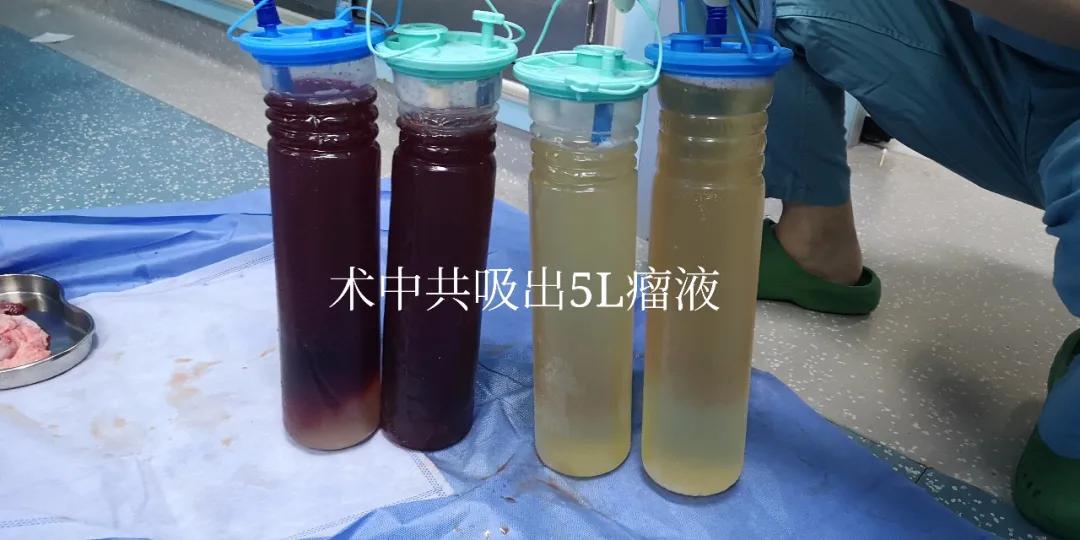 丨传承·创新丨短期内腹部增大要警惕！未必是胖，可能是病——单孔腔镜开启外科微创手术的“无痕”时代