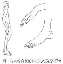 高以翔是有什么病吗,高以翔是心脏病还是脑溢血