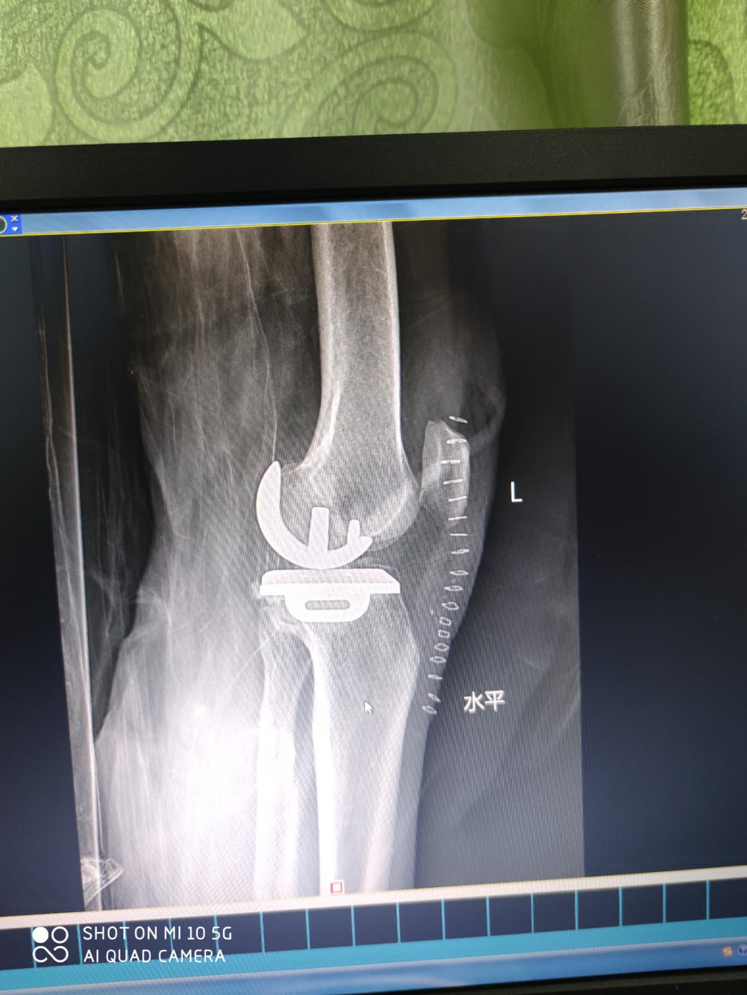 百色市人民医院关节外科开展膝关节单髁置换术,保膝技术再添“法宝”