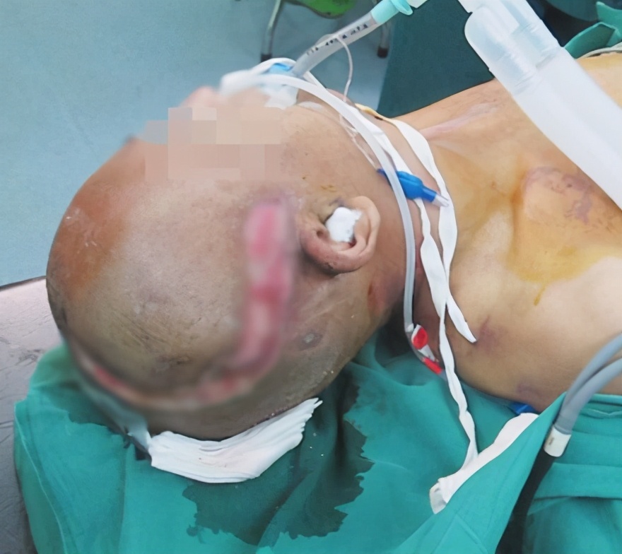 脑外伤开颅手术后脑积水,脑外伤手术后脑脊液鼻漏怎么治疗