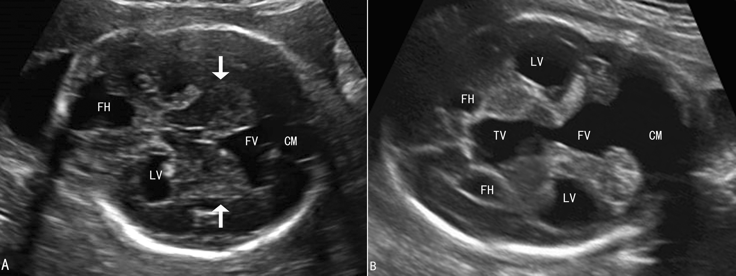 胎儿颅脑中线异常的超声诊断思路,胎儿颅内结构异常超声图片