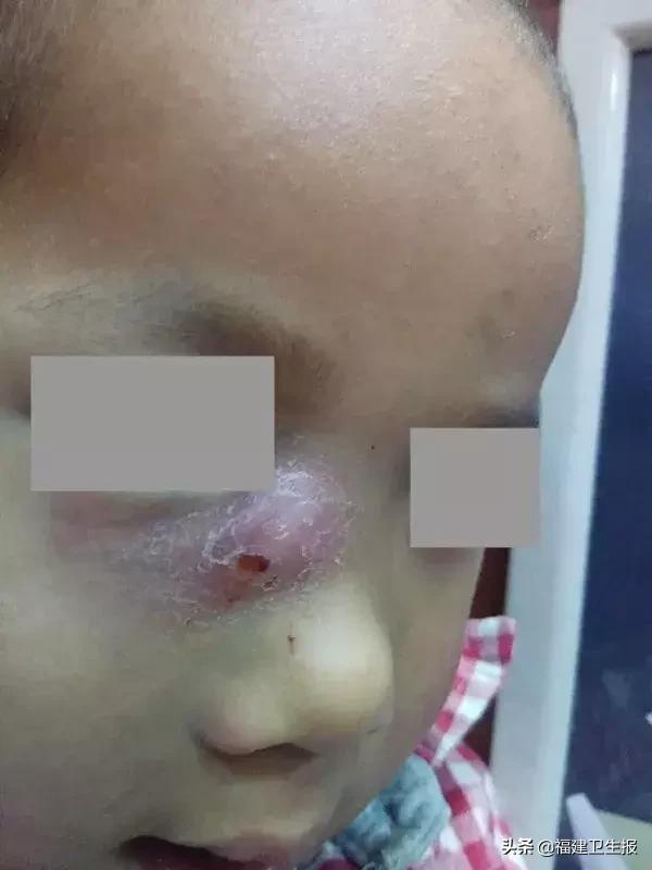 小孩牙齿蛀了一个小洞,四岁男孩牙齿全被虫蛀