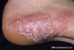 脚气皮肤科医生怎么说,皮肤科医生脚气小妙方