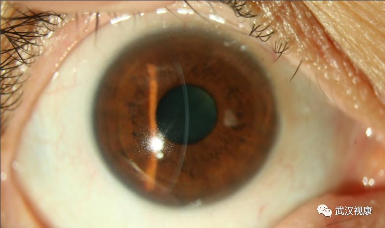 近视眼手术的发展史动画,近视眼手术发展史图片